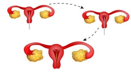 illustration of the process of making intrauterine devices